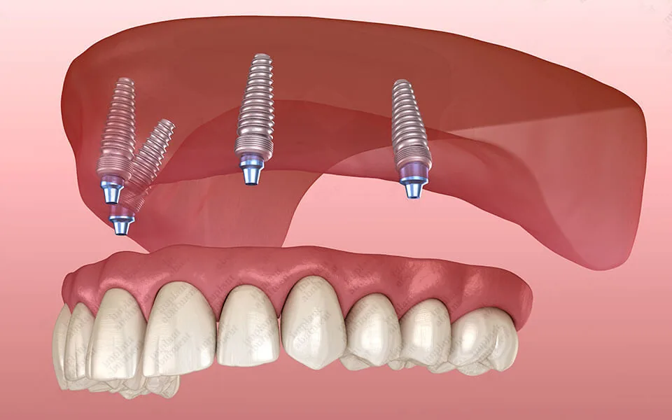 All on 4 implants