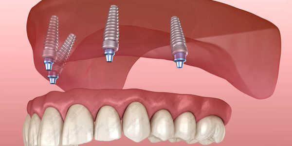 How to Clean All-on-4 Implants