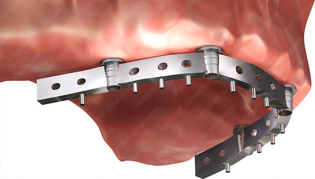 Everything You Need to Know About Multi-Unit Implant Abutments
