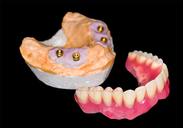 The Lowdown on Overdenture Systems and Their Abutments