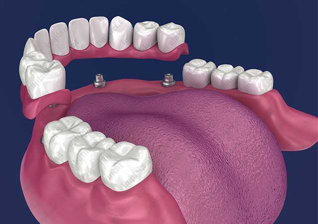 The Case for Partial Overdentures